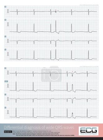 Photo for An 81-year-old man with a clinical diagnosis of coronary heart disease and morbid sinus syndrome. Slow junctional escape rhythm was accompanied by wide QRS waves. - Royalty Free Image