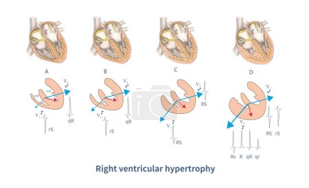 Foto de Durante la despolarización ventricular, diversos grados de hipertrofia ventricular derecha y confrontación ventricular izquierda producen diferentes formas de hipertrofia ventricular derecha ECG. - Imagen libre de derechos