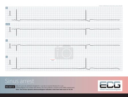 Photo for An 81 year old elderly male was clinically diagnosed with coronary heart disease and cerebral vascular insufficiency. The dynamic electrocardiogram indicated sick sinus syndrome. - Royalty Free Image