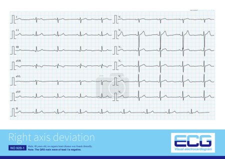 Photo for Right axis deviation can be seen both in right ventricular hypertrophy and in some healthy people, who have no ECG abnormalities except for right axis deviation. - Royalty Free Image