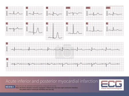 Photo for Male, 84 years old, admitted to hospital with chest pain for 1 day. ECG showed acute inferior and posterior MI and possibly right MI. The patient died of ventricular fibrillation the next day. - Royalty Free Image