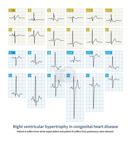 Foto de Diferentes pacientes con cardiopatía congénita tienen diferentes patrones de ECG para la hipertrofia ventricular derecha, dependiendo de la sobrecarga de diástole o de la sobrecarga sistólica.. - Imagen libre de derechos
