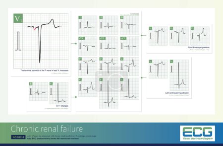 Photo for Common ECG changes in chronic renal insufficiency include left ventricular hypertrophy, left atrial abnormality, poor R wave progression and ST-T changes. - Royalty Free Image