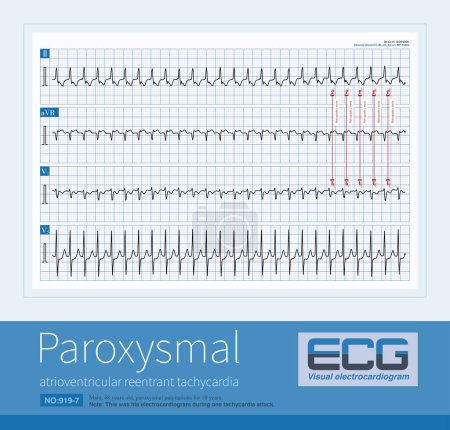 Photo for Male, 48 years old, paroxysmal palpitations for 10 years. ECG showed left posterior septum bypass tract and paroxysmal supraventricular tachycardia. - Royalty Free Image