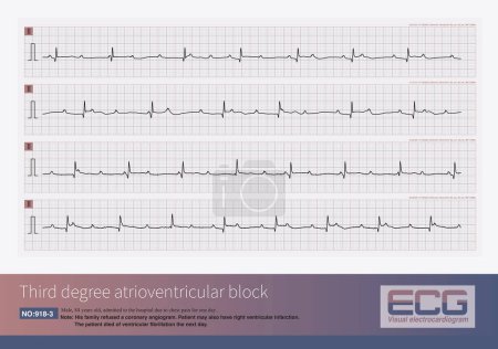 Photo for Male, 84 years old, admitted to hospital with chest pain for 1 day. These ECG rhythms are the Holter monitor records of the patients after admission, and they are third degree atrioventricular block. - Royalty Free Image