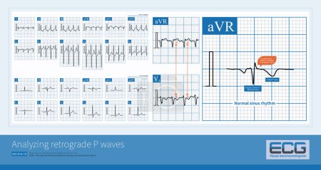 Photo for In atrioventricular reentrant tachycardia, the retrograde P-wave appears after the QRS wave, and can be upright or inverted depending on the lead. - Royalty Free Image