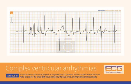 Photo for A 4-year-old boy with a clinical diagnosis of long QT syndrome. No genetic testing was done during hospitalization. The child died suddenly during follow-up. - Royalty Free Image