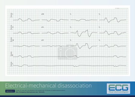 Photo for Female, 85 years old, was admitted to the hospital after 20 minutes of sudden unconsciousness. The admission ECG  indicated electrical mechanical disassociation, which is a type of cardiac arrest. - Royalty Free Image