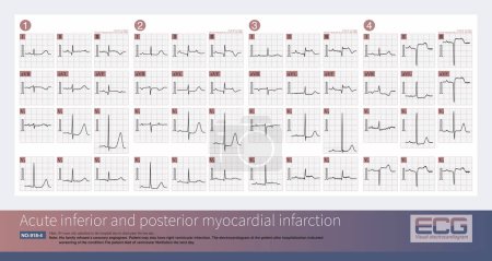 Photo for Male, 84 years old, admitted to hospital with chest pain for 1 day. These ECG rhythms are the Holter monitor records of the patients after admission, and they are third degree atrioventricular block. - Royalty Free Image