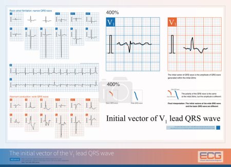 Téléchargez les photos : Lorsqu'une onde QRS large se produit, le même vecteur initial de l'onde QRS principale V1 indique une conduction aberrante, alors que les différences ne peuvent pas distinguer entre les battements de conduction ventriculaire et aberrante.. - en image libre de droit