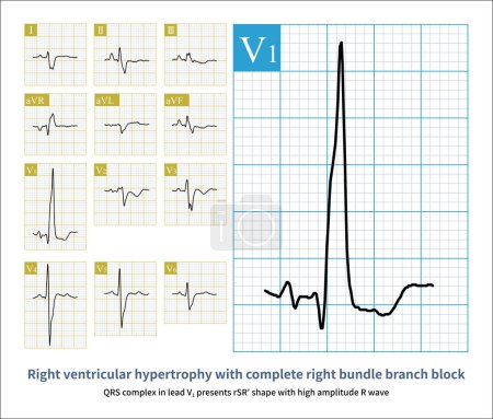 Photo for QRS complex in lead V1 presents rSR shape with high amplitude R wave.The electrocardiogram of a patient with atrial septal defect showed right ventricular hypertrophy with complete RBBB. - Royalty Free Image