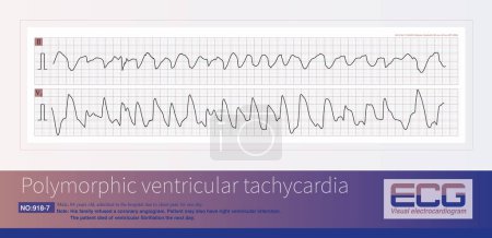 Photo for Male, 84 years old, admitted to hospital with chest pain for 1 day. ECG showed acute inferior and posterior MI and possibly right MI. The patient died of ventricular fibrillation the next day. - Royalty Free Image