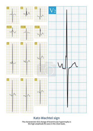 Photo for A 19-year-old young man suffering from ventricular septal defect has developed secondary pulmonary hypertension, and his electrocardiogram indicates biventricular hypertrophy. - Royalty Free Image
