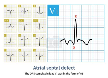 Varón, 13 años, diagnosticado clínicamente con comunicación interauricular secundum. Tenga en cuenta que la onda QRS en el plomo V1 del electrocardiograma tiene una forma qR, lo que indica hipertrofia ventricular derecha.