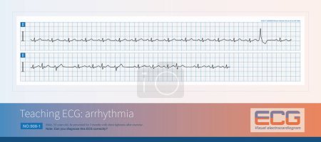 Photo for Ventricular premature contractions are a common arrhythmia, but they do not necessarily indicate that patients may have organic heart disease, and may only be idiopathic arrhythmias. - Royalty Free Image