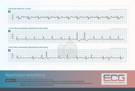 Photo for Male, 65 years old. The clinical diagnosis was  acute anterior wall myocardial infarction. After opening the criminal's blood vessel, the patient developed reperfusion arrhythmia. - Royalty Free Image