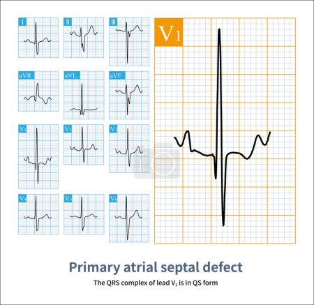 Photo for A 7-year-old male patient with a primary foramen atrial septal defect was clinically diagnosed. The electrocardiogram shows right ventricular hypertrophy and intraventricular block pattern. - Royalty Free Image