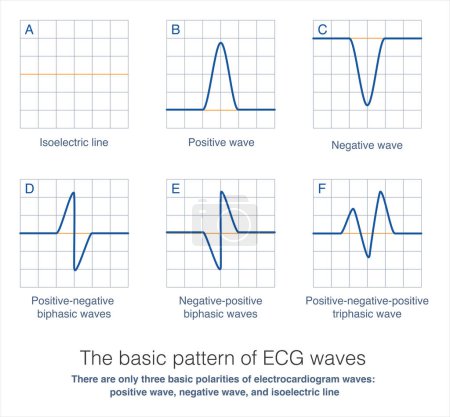 Photo for There are only three basic polarities in electrocardiogram recordings: isoelectric  line, positive wave above isoelectric  line, and negative wave below isoelectric  line. - Royalty Free Image
