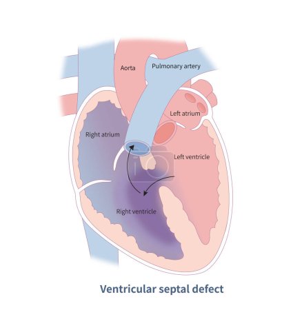 Foto de La comunicación interventricular es una derivación de izquierda a derecha a nivel ventricular, y también es una cardiopatía congénita común que puede causar agrandamiento ventricular izquierdo e hipertrofia.. - Imagen libre de derechos