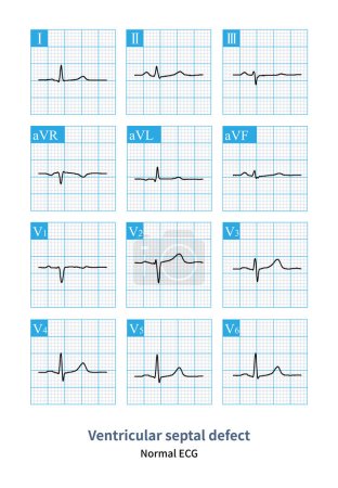 Photo for When a small ventricular septal defect has little or even no impact on hemodynamics, the patient's electrocardiogram can be completely or roughly normal. - Royalty Free Image
