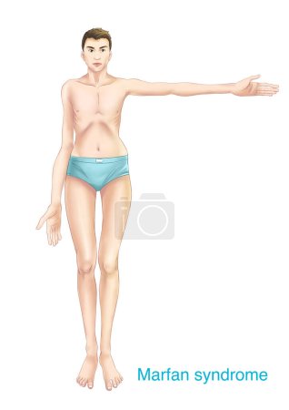 Photo for Marfan syndrome is an autosomal dominant connective tissue disease characterized by elongated limbs, cardiovascular system abnormalities, and sudden death. - Royalty Free Image