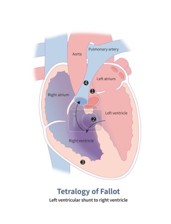 Quatre malformations anatomiques de la tétralogie de Fallot : 1 chevauchement aortique ; 2 défauts du septum ventriculaire ; 3 hypertrophie ventriculaire droite et 4 sténose de l'artère pulmonaire.