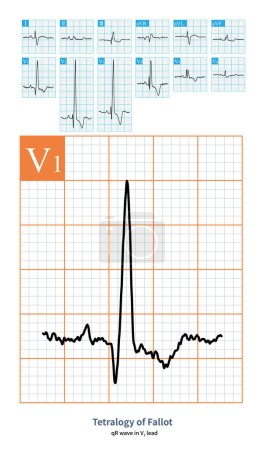 Photo for Female, 7 years old, clinically diagnosed with Tetralogy of Fallot. This electrocardiogram was collected after she underwent repair surgery, indicating right ventricular hypertrophy. - Royalty Free Image