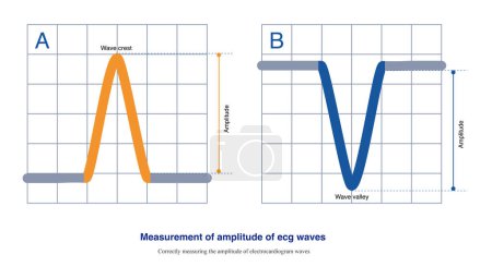 Foto de Cuando la polaridad de la onda ECG es diferente, existen dos métodos para medir la amplitud de la onda ECG, los cuales miden desde un cierto borde de la línea base hasta el vértice de la onda ECG.. - Imagen libre de derechos