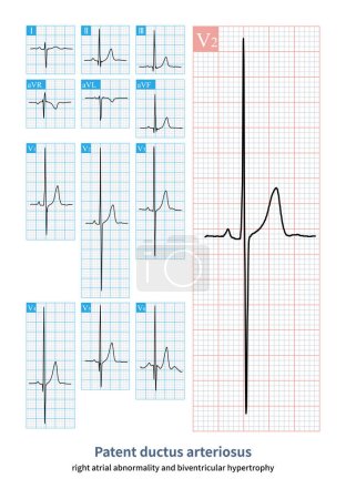Photo for Male, 11 years old, clinically diagnosed with patent ductus arteriosus. Electrocardiogram diagnosis of sinus rhythm, right atrial abnormalities, and bilateral ventricular hypertrophy. - Royalty Free Image