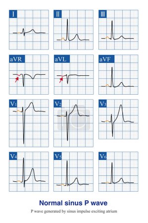 Photo for Under normal circumstances, the sinus P wave is the first ECG wave, as the sinus node is very small and the electrical activity generated cannot be recorded by the ECG machine. - Royalty Free Image