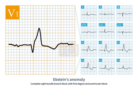 Photo for Female, 50 years old, clinically diagnosed as Ebstein's anomaly. Electrocardiogram showed sinus arrhythmia, first degree atrioventricular block and complete right bundle branch block. - Royalty Free Image