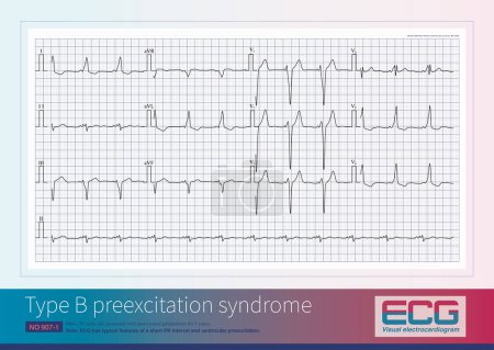 Photo for Male, 39 years old, presented with paroxysmal palpitations for 5 years. ECG has typical features of a short PR interval and ventricular preexcitation. - Royalty Free Image