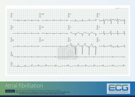 Photo for This was another ECG in patients with hyperkalemia after potassium normalizes and suggested atrial fibrillation and incomplete right bundle branch block. - Royalty Free Image