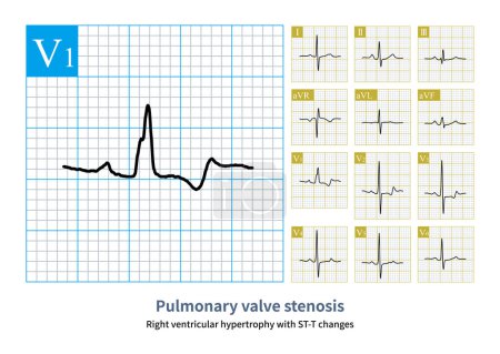 Photo for The patient, female, 49 years old, was clinically diagnosed with pulmonary valve stenosis. The electrocardiogram indicates right ventricular hypertrophy. - Royalty Free Image