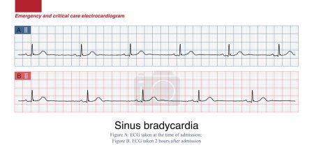 Foto de A 67-year-old man presents with heart palpitations, numbness of the lips and nausea after consuming poisonous shellfish. ECG showed sinus bradycardia. - Imagen libre de derechos