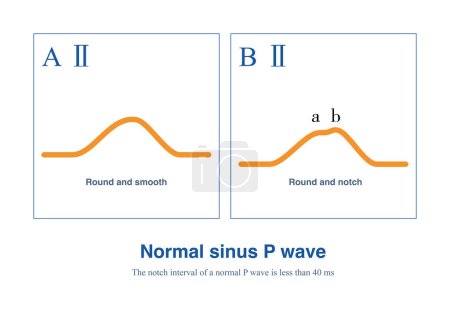 Photo for The morphology of a normal P wave can be smooth or notched, but the peak-to-peak spacing formed by the notch must be less than 40 ms. - Royalty Free Image