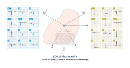 Photo for The characteristic of a dexiocardia ECG  is that in the limb lead, the left and right upper limbs exchange with each other, while in the chest lead, the QRS amplitude decreases. - Royalty Free Image