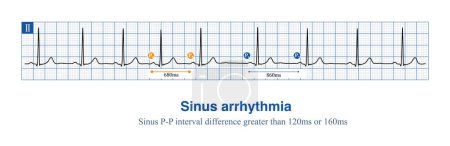 Photo for Sinus arrhythmia is a very common benign arrhythmia that does not require treatment. It can be diagnosed with a sinus cycle difference of more than 120ms or 160ms. - Royalty Free Image
