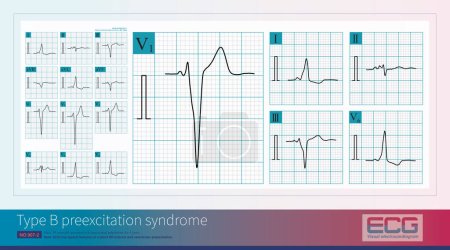Photo for Male, 39 years old, presented with paroxysmal palpitations for 5 years. ECG has typical features of a short PR interval and ventricular preexcitation. - Royalty Free Image