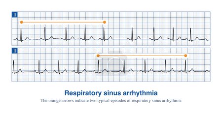 Téléchargez les photos : L'arythmie des sinus respiratoires est diagnostiquée lorsque la fréquence cardiaque augmente pendant l'inspiration et ralentit pendant l'expiration, et que la différence entre l'intervalle P-P dépasse 120 ou 160 ms. - en image libre de droit