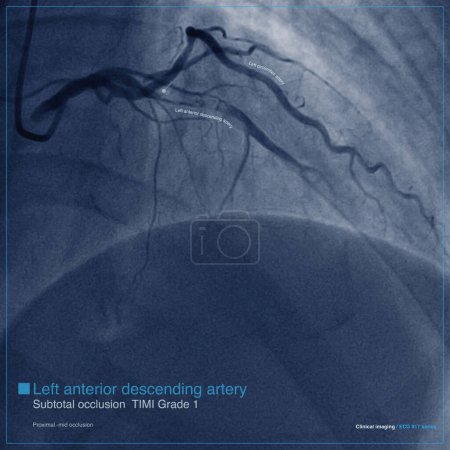 Photo for Male, 65 years old, admitted with chest pain for 2 hours. Coronary angiography indicates subtotal occlusion of the proximal to middle segment of the left anterior descending artery. - Royalty Free Image