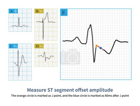 Firstly, select point J as the reference point, and then select 60ms after point J as the measurement point to evaluate the ST segment offset morphology and amplitude.