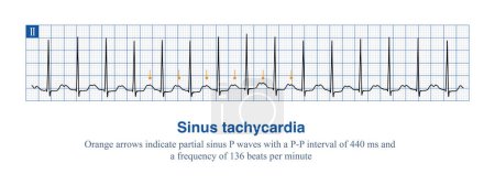 Photo for The frequency of sinus impulses exceeds 100 beats per minute, and the electrocardiogram diagnosis is sinus tachycardia. The important differential diagnosis is atrial tachycardia. - Royalty Free Image