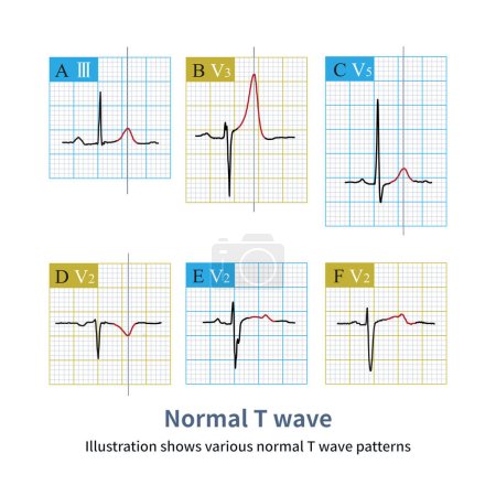 Photo for There are many morphologies of normal T waves, and some are tall, low, notched, and inverted T waves that can be confused with pathological T wave changes. - Royalty Free Image