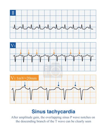 Photo for When the frequency of sinus tachycardia is too rapid, the sinus P wave can overlap on the previous T wave, making it difficult for beginners to interpret the P wave. - Royalty Free Image