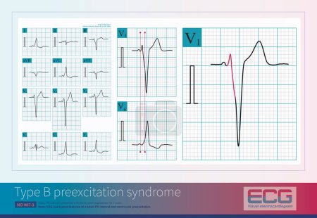 Photo for Male, 39 years old, paroxysmal palpitations for 5 years. ECG showed B type ventricular preexcitation.This diagram shows how to measure ventricular preexcitation components simultaneously. - Royalty Free Image