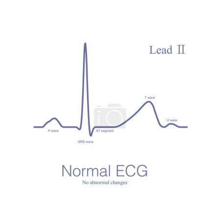 Téléchargez les photos : Un ECG normal est un ECG qui n'a pas de changements anormaux et peut être vu chez les personnes en bonne santé ainsi que chez les personnes atteintes de maladie cardiaque. - en image libre de droit