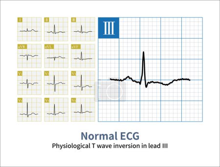 Under physiological conditions, T waves in leads III, aVL, and V1 can exhibit inversion However, sometimes it is necessary to differentiate it from pathological T wave inversion.
