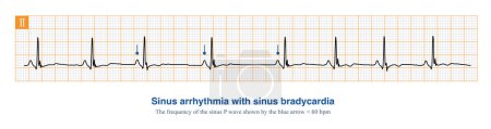 In der klinischen Praxis treten Sinus-Arrhythmien häufig zusammen mit Sinus-Bradykardie auf, die größtenteils physiologische Rhythmusänderungen sind und keine therapeutische Bedeutung haben..