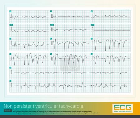 Male, 52 years old, diagnosed with acute extensive anterior wall myocardial infarction. The patient repeatedly experienced ventricular tachycardia and eventually died of cardiogenic shock.